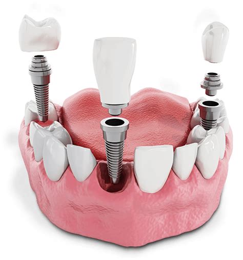 multiple dental implants onalaska